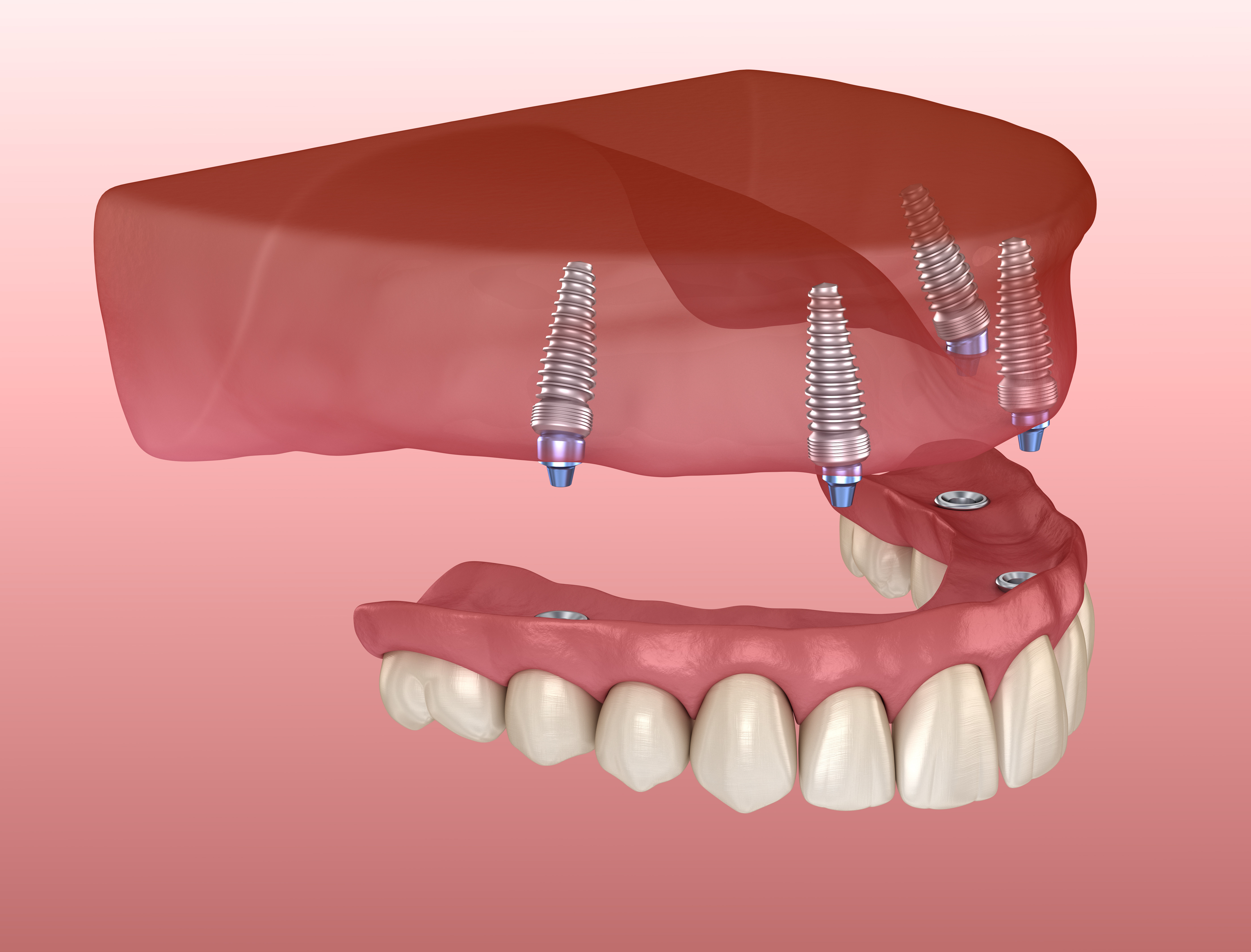 implantología dental